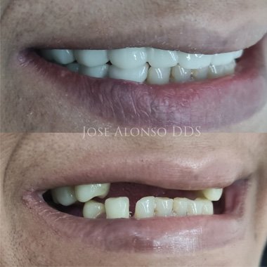 Before Smile Makeover Jose Alonso dds
