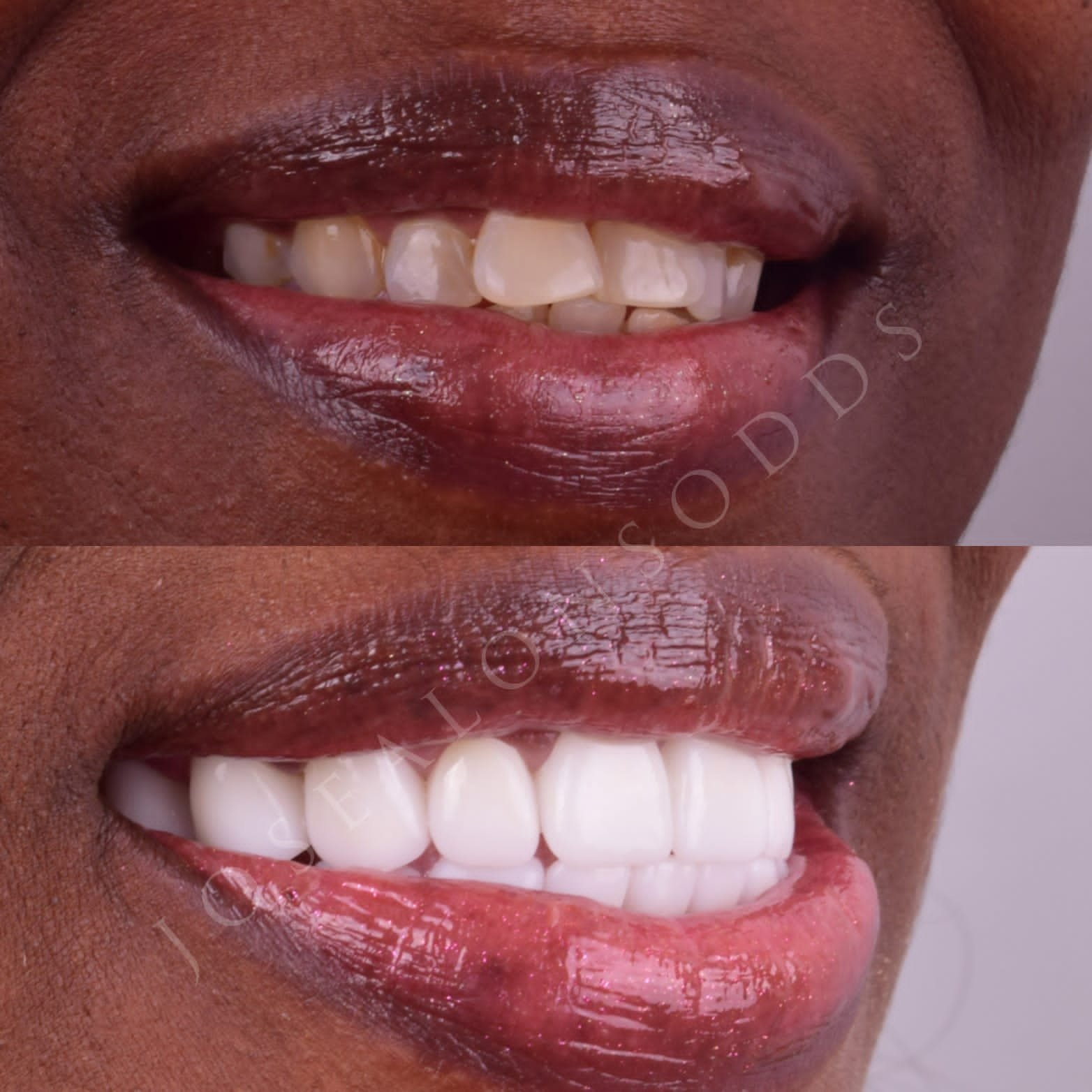 Smile makeover with Full Contour Porcelain Crowns