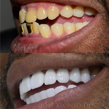 Before and After Porcelain Crowns Dominican Republic