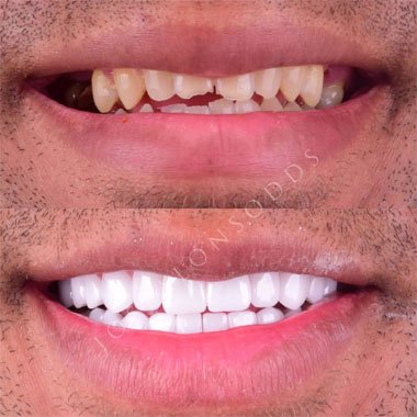Smile Makeover Patient