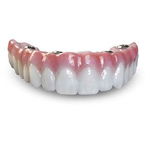 Bruxzir Full Arch Implant Bridge