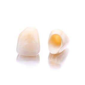 Full Contour Porcelain Crown