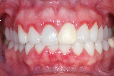 Patient Gingivitis