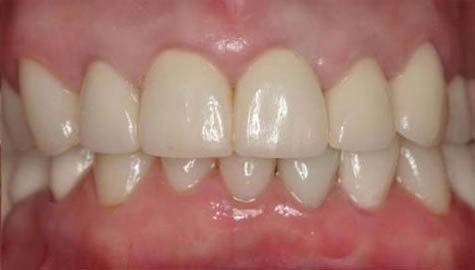 Patient Gingivitis