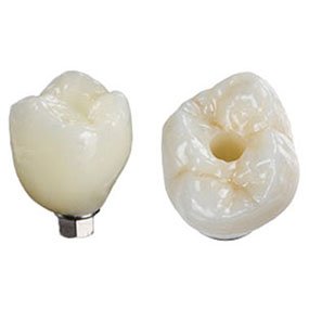 Porcelain Implant Crown Dominican Republic