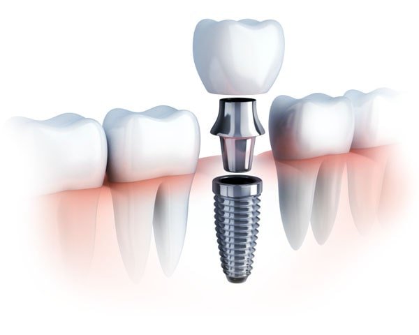 Implant Parts Dominican Republic