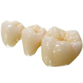 Full Contour Porcelain Bridge