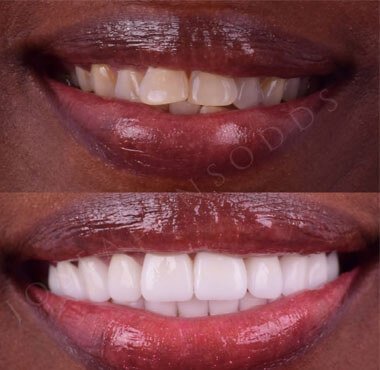 Smile Makeover with Crowns and Bridges