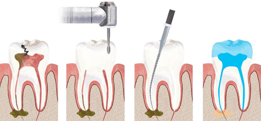 Zoom Whitening Dominican Republic