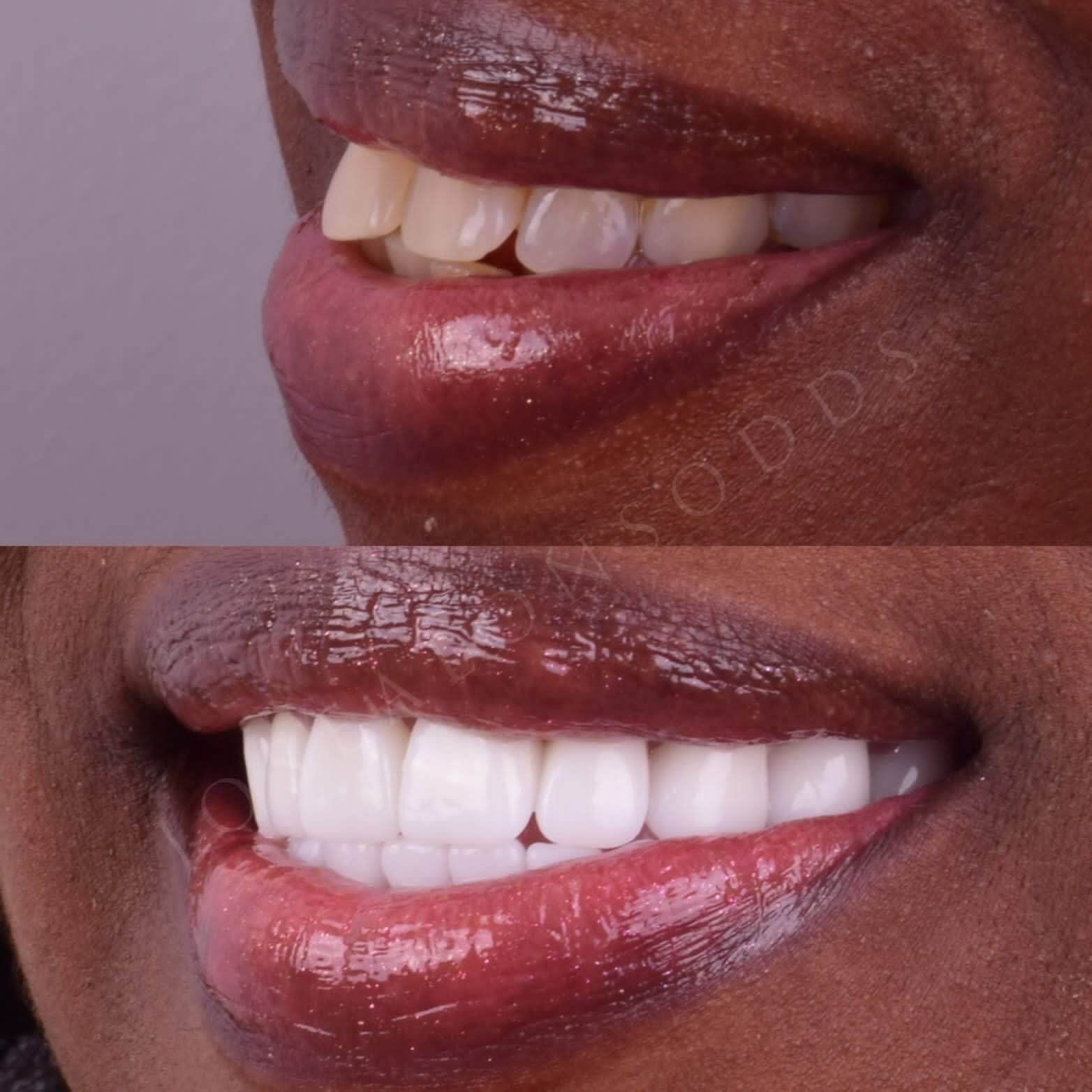 Smile Makeover with Crowns and Bridges santo domingo