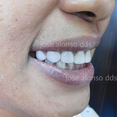 Smile Makeover After Picture Dr. Alonso